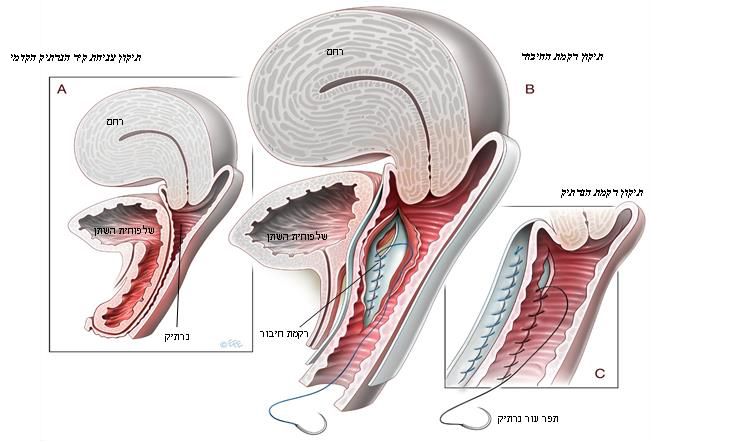 הרמת שלפוחית השתן