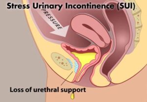 סרט תת שופכתי