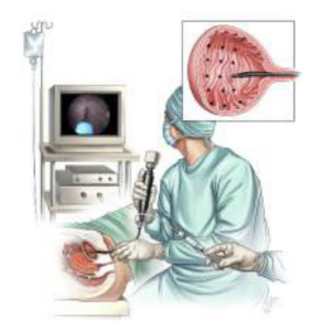 טיפול בהזרקות בוטוקס לכיס השתן