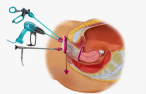 כריתת שחלות מניעתית ללא צלקות VNOTES2